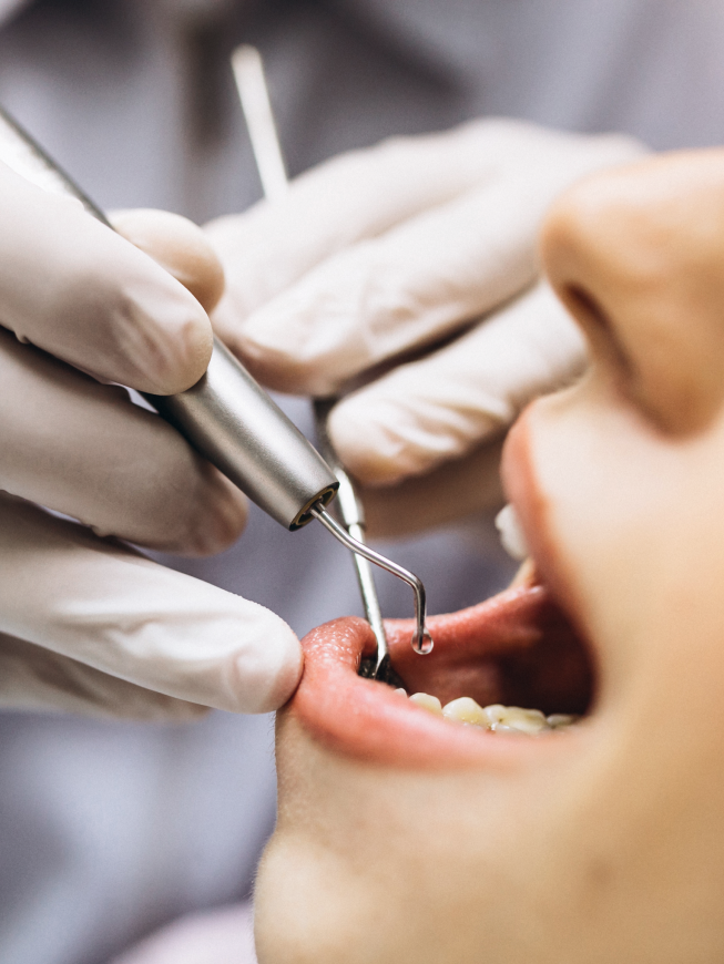 Professional dental treatment in Astoria, NY, dental sealants and fillings photo