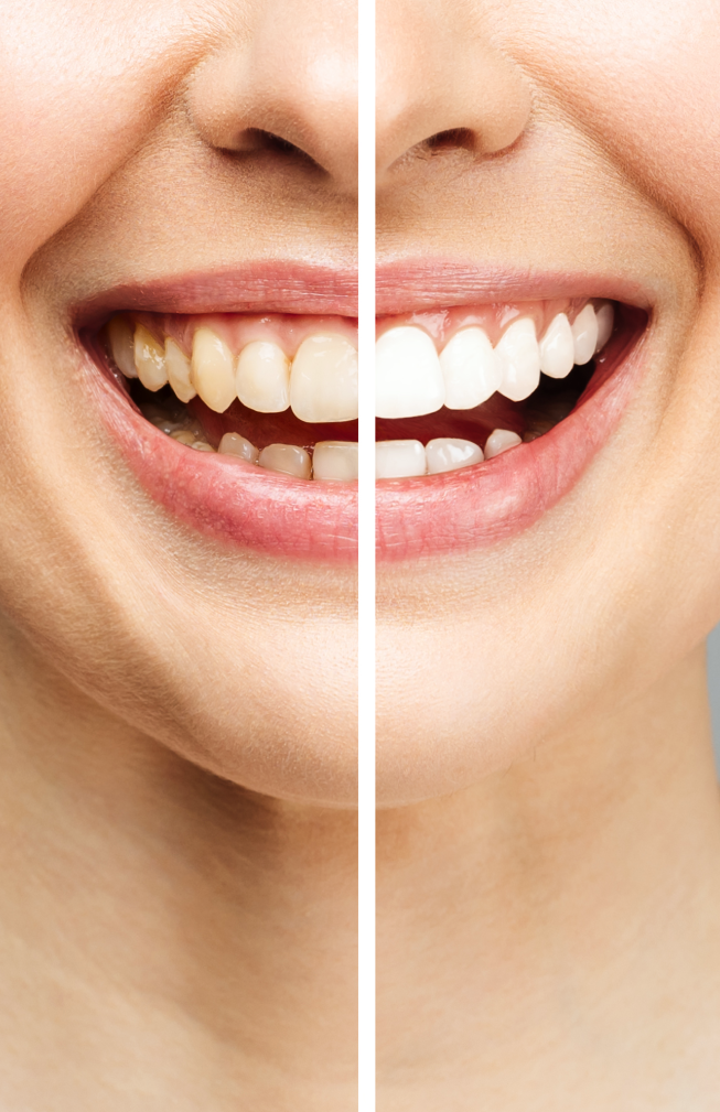 Professional dentist in Astoria, NY, before and after photo