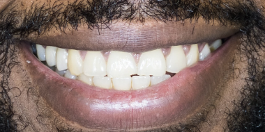 Luna Dental Astoria NY, results photo