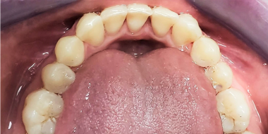 Luna Dental Astoria NY, dental treatment results photo