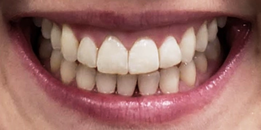 Luna Dental Astoria NY, cosmetic dentistry results photo