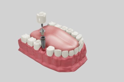 Dental implants image, picture