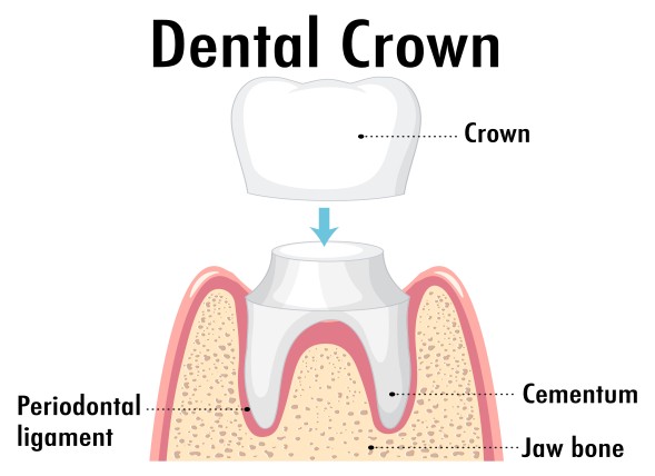 vector infographic of human in dental crown