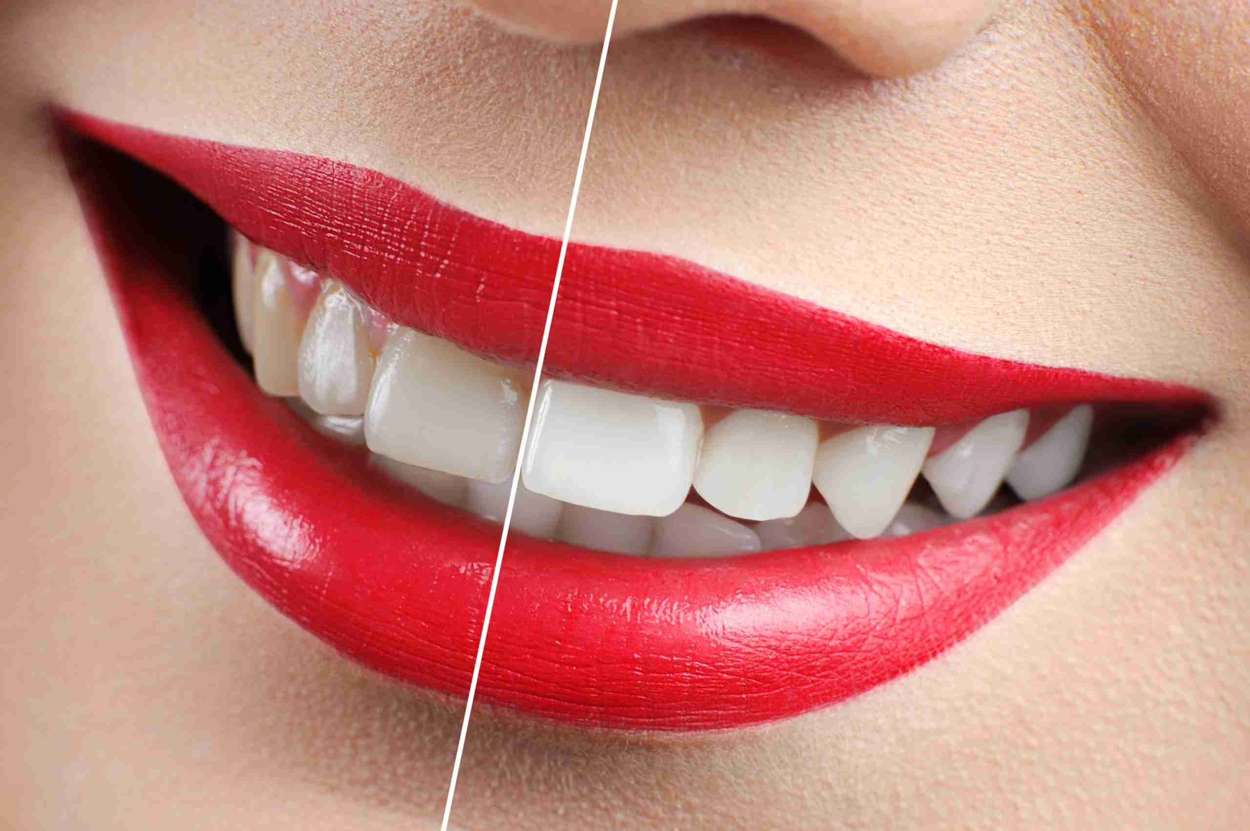 Teeth Whitening in Astoria, Queens: Enhance Your Smile at Our Top Dental Clinic