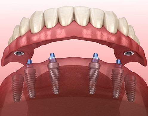 All-on-4 and All-on-6 dental implants full arch restoration diagram